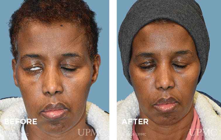 Patient with flaccid facial paralysis after right eyelid weight placement.